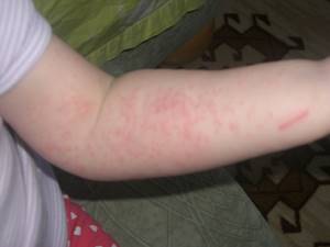 Аллергия на теле