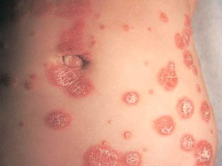 Аллергия на ремень на животе