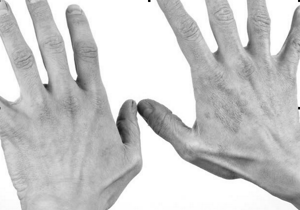 Аллергия на латексные перчатки
