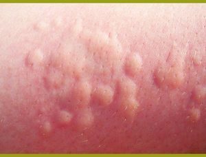 Аллергия на кефир у взрослых симптомы