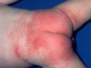 Как выглядит аллергия у младенца