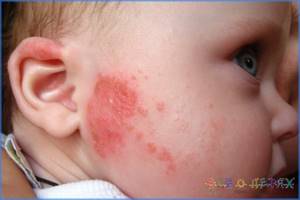 Аллергия у ребенка 6 лет