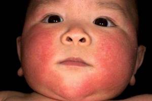 У грудничка аллергия на лице что делать