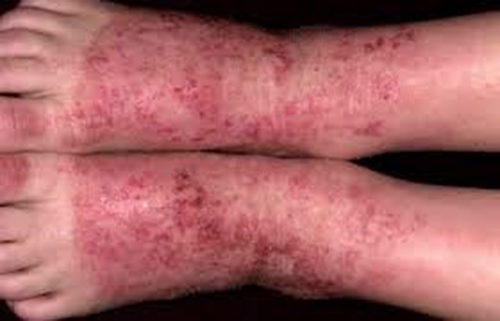 Чем лечить дерматит на ногах