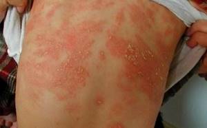 Аллергический дерматит симптомы и лечение у детей