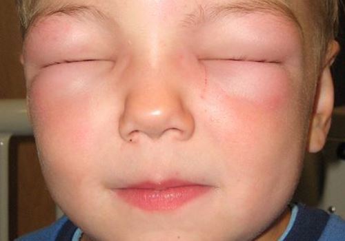 Отек лица при аллергии