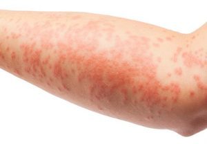 Инфекционный дерматит лечение