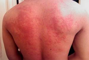 Аллергия на пот лечение