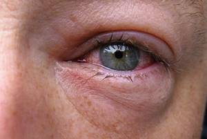 Аллергия на сельдерей симптомы