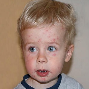 Аллергия у ребенка 2 года
