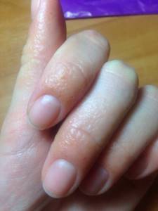 Аллергия на нарощенные ногти