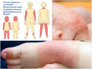 Калина от аллергии у детей