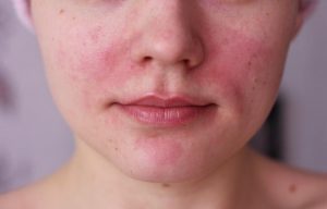 Лечение контактного дерматита на лице