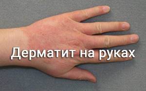 Сухой дерматит на руках