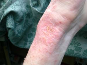 Аллергия на моющие средства