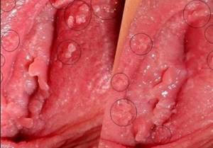 Аллергия на гениталиях