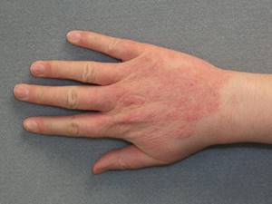 Мазь от контактного дерматита на руках