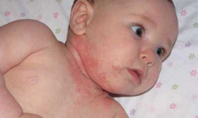 Как выглядит дерматит у детей