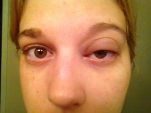 Как снять отек с глаза при аллергии
