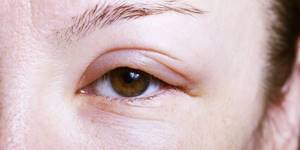 Отек глаз при аллергии у ребенка