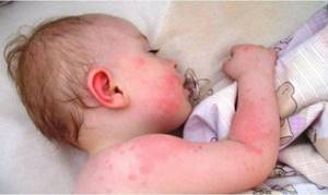 Как выглядит аллергия на солнце у детей