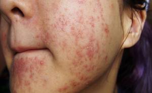Аллергическая сыпь симптомы