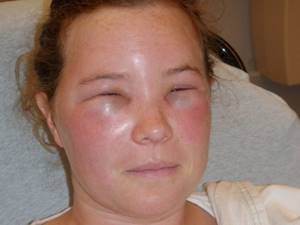 Аллергия на шерсть как проявляется