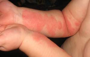 Аллергический дерматит на пальцах рук