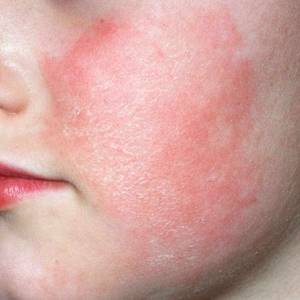 Аллергия на порошок ушастый нянь