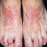 Чем лечить дерматит на ногах