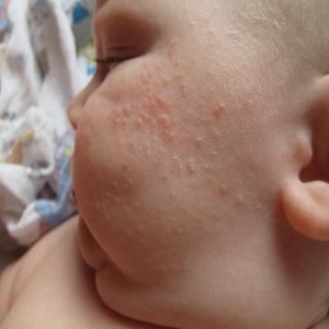 Мазь от аллергии для детей до года