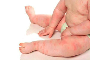 Как долго проходит аллергия у ребенка