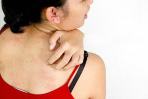 Можно ли мыться при аллергии на коже