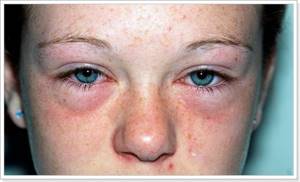 Как определить аллергический насморк или нет
