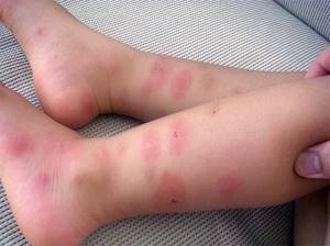 Лечение при аллергии кожи с зудом