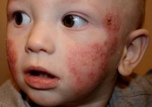 Признаки пищевой аллергии у детей