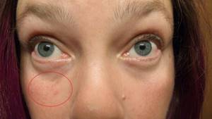 Пищевая аллергия на лице у взрослых