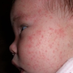 Крем от аллергии для новорожденных