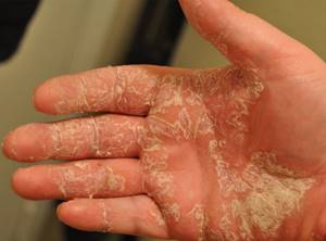 Как лечить экзему на пальцах рук