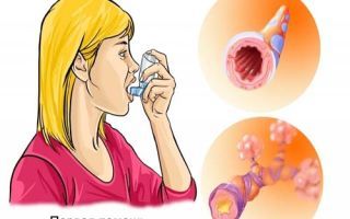 Что делать при бронхиальной астме