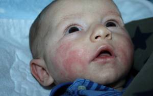 Аллергия на лице у грудничка лечение