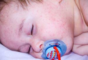Аллергия на яичный белок у ребенка