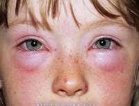Аллергия на животных симптомы