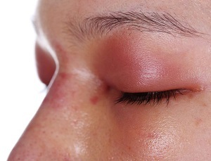 Капли для глаз от аллергии кромогексал