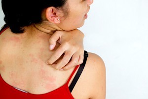 Аллергия крапивница причины