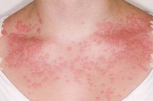 Что происходит в организме при аллергии