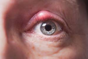 Зуд в глазах при аллергии лечение