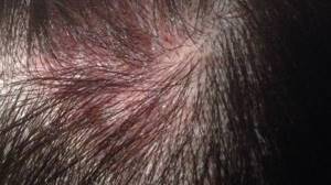 Шампунь от аллергии кожи головы