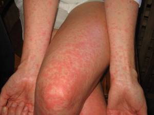 Аллергия на солнце симптомы лечение