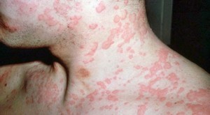 Аллергическое покраснение кожи